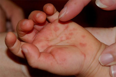 bệnh tay chân miệng ở trẻ em