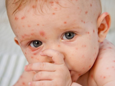 Bệnh Rubella khác gì với bệnh sởi?