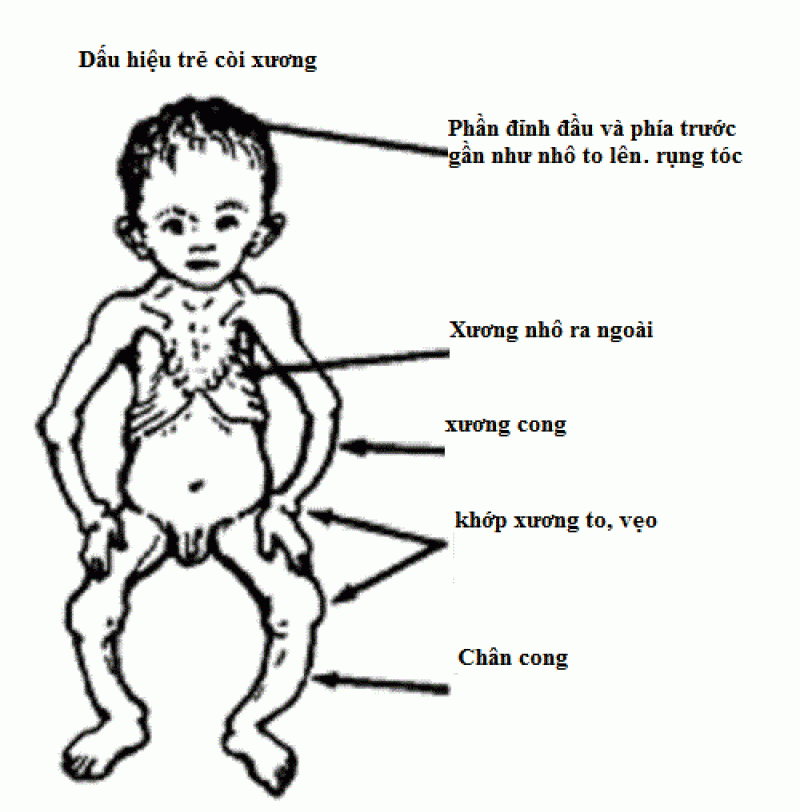 Trẻ bị còi xương và những phương pháp phòng chống