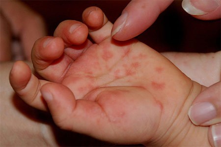 bệnh tay chân miệng ở trẻ em